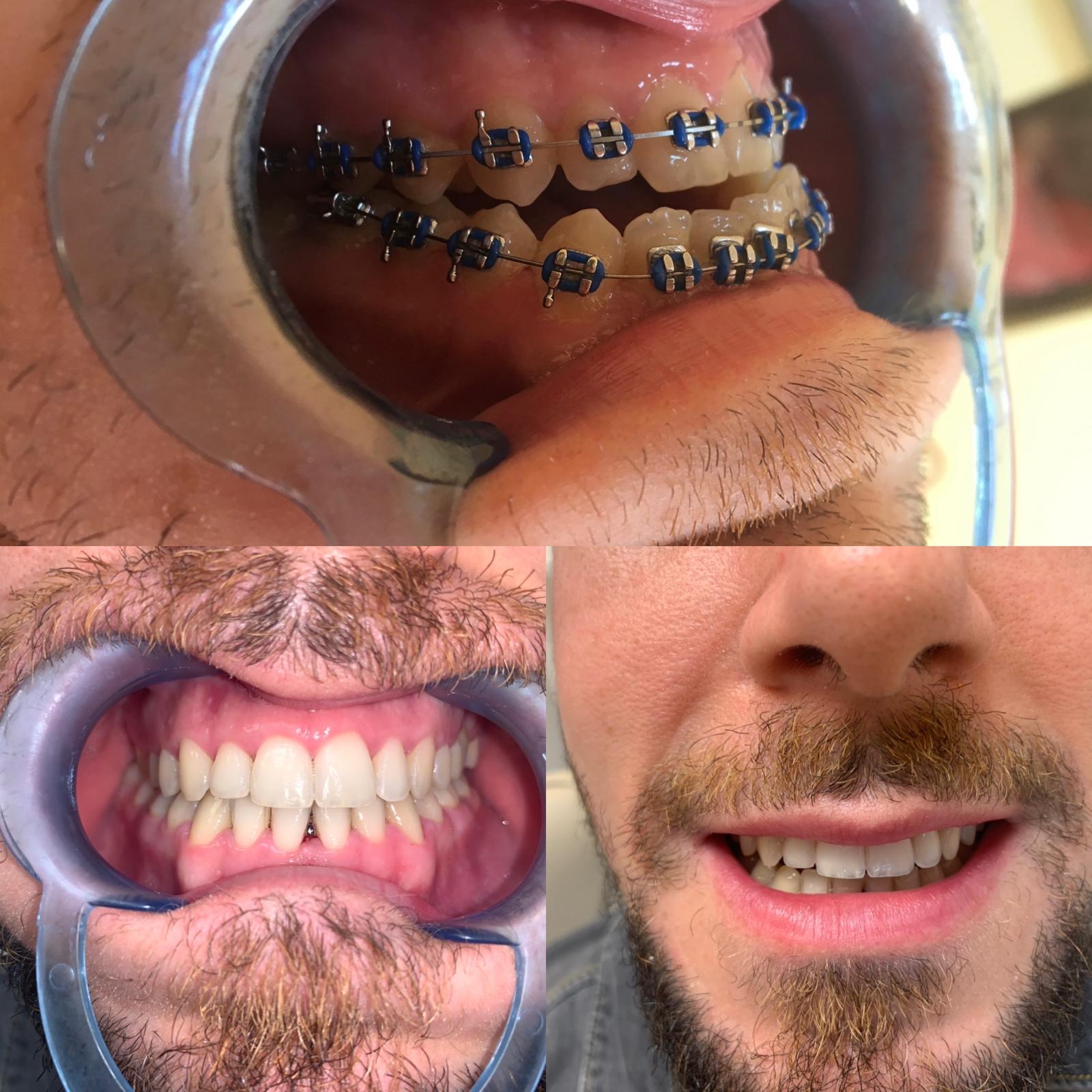 Tratament ortodontic cu aparat metalic - aparat dentar Caransebes