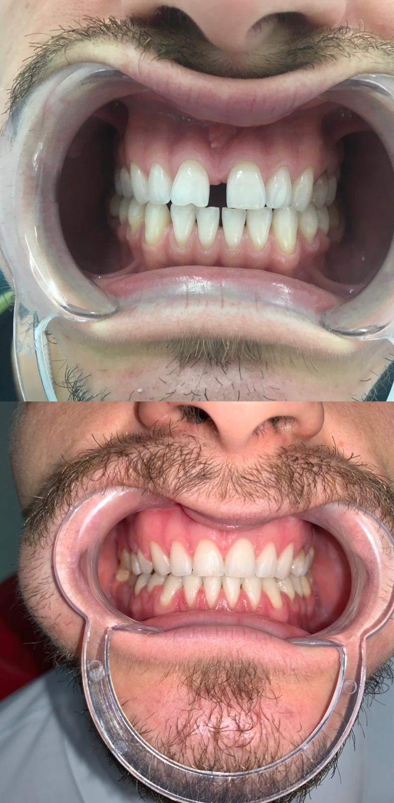 Corectie diastema spatiu intre dinti - aparat dentar Caransebes