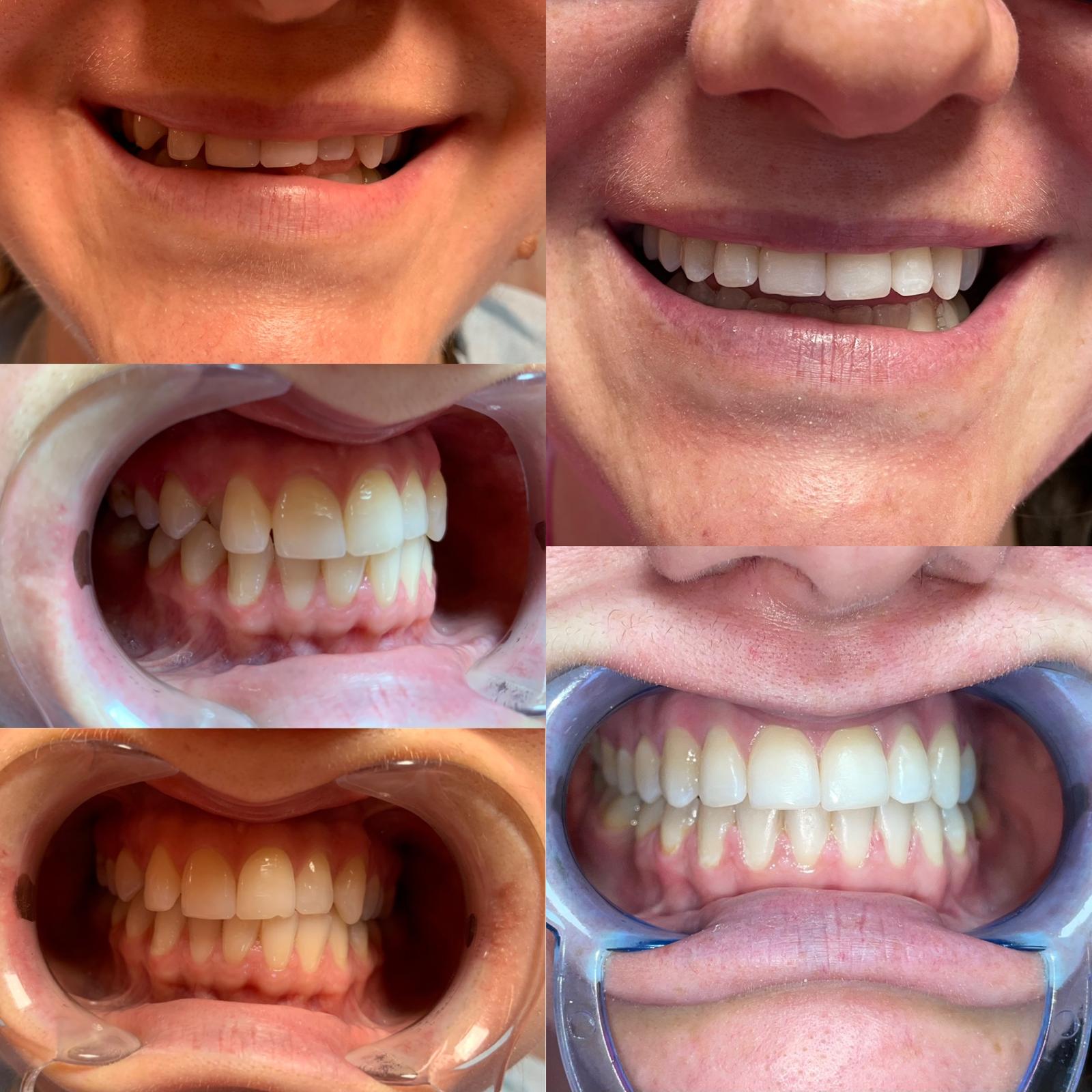 Rezultate tratament ortodontic - cabinet ortodontic Caransebes