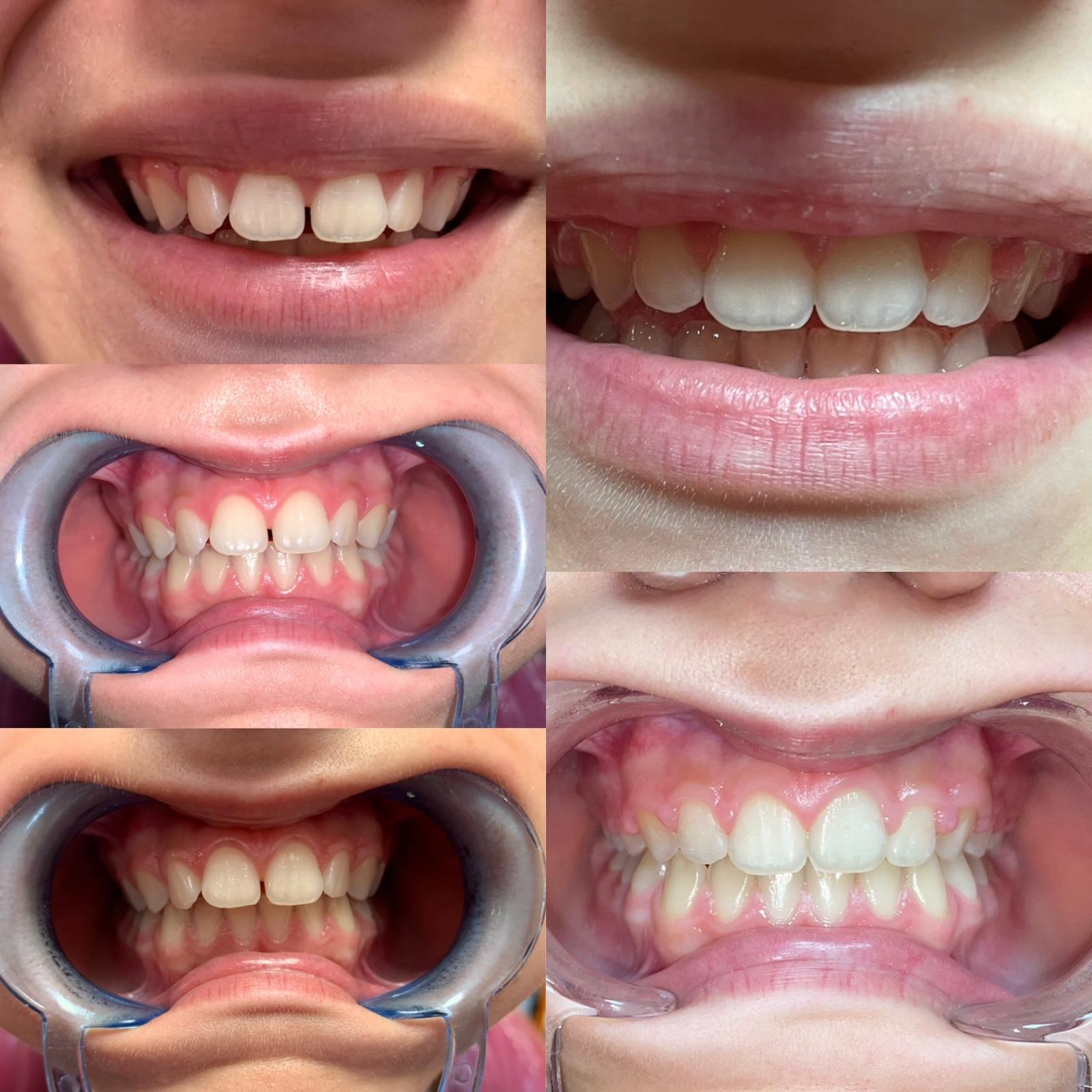 Aliniere dentara completa - ortodont Caransebes