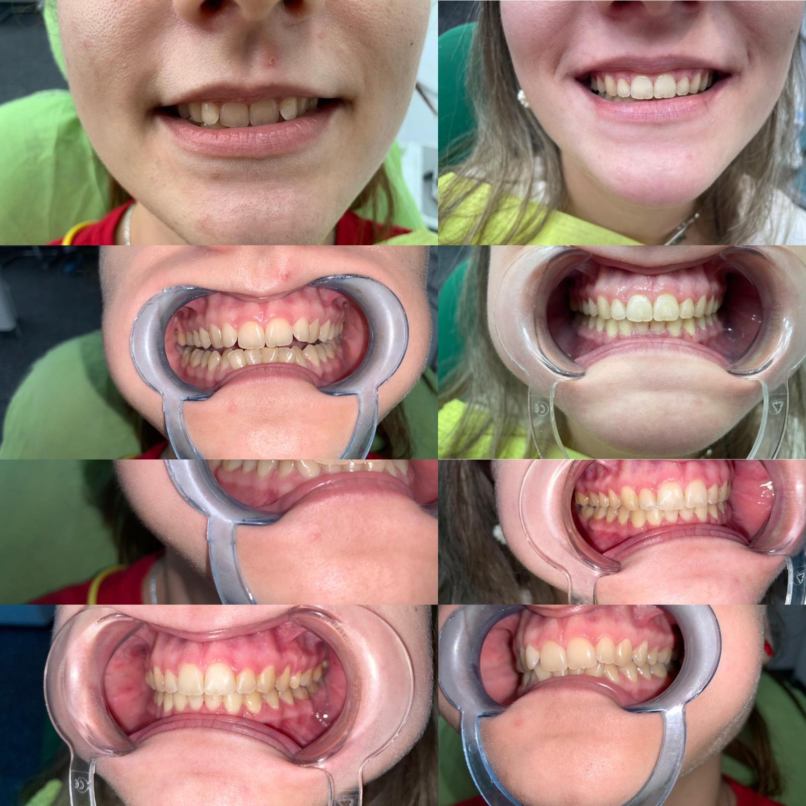 Tratament ortodontic interceptiv copii - ortodontie Caransebes