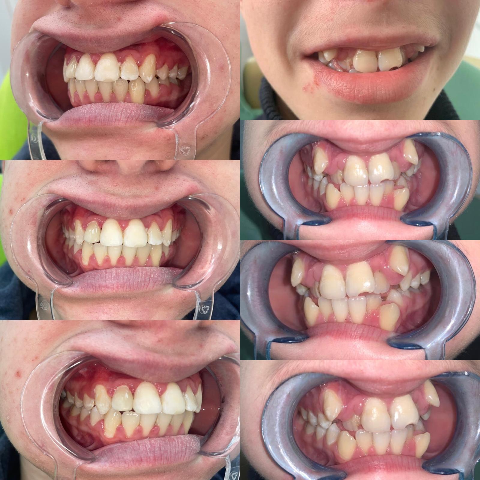 Corectie malpozitie dentara - aparat dentar Caransebes