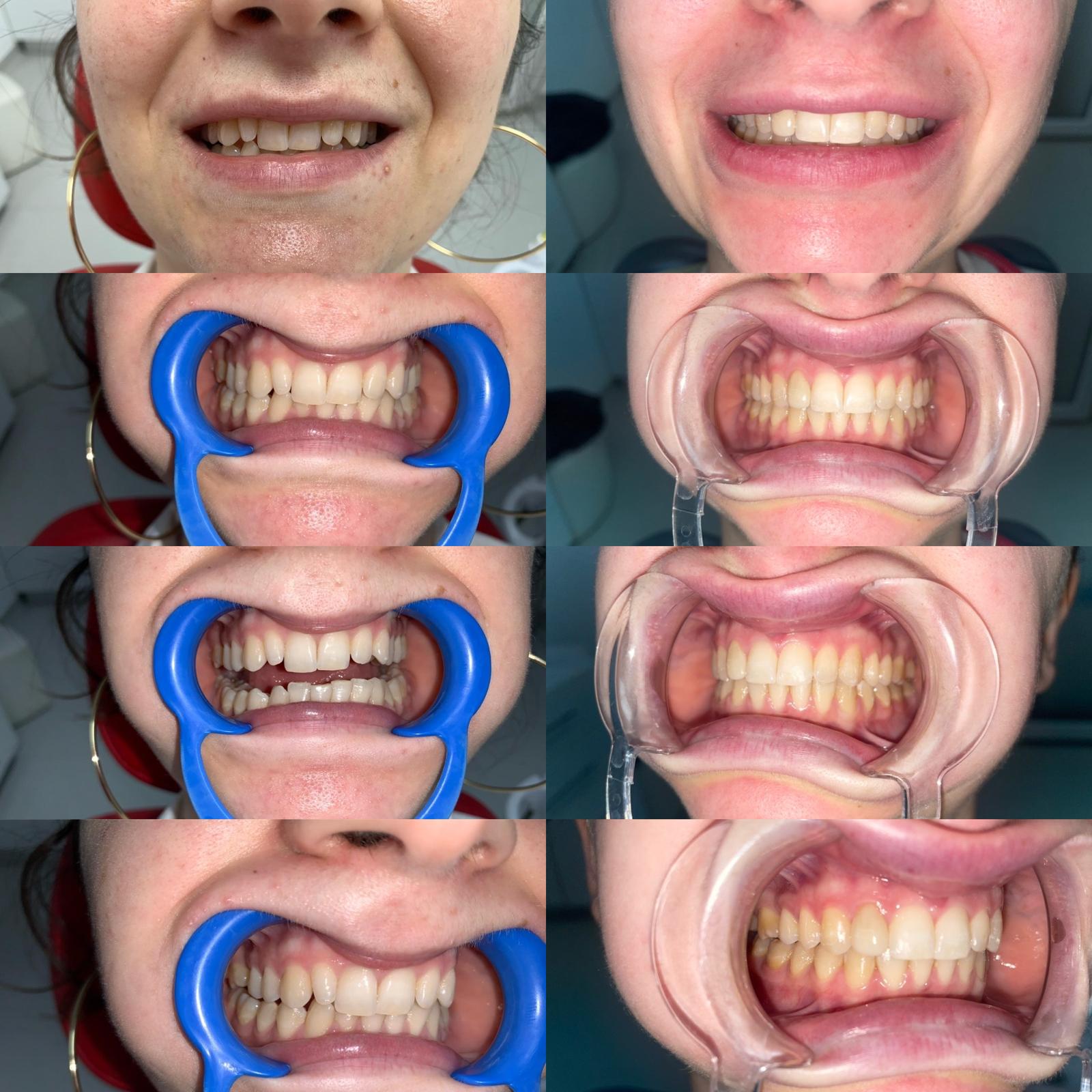 Rezultate finale tratament ortodontic - Dr. Dana Visan Caransebes